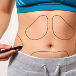 Can Mini Tummy Tuck Tighten Lower Belly Skin