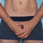 Can P-Shot Help Men With Intimacy Concerns Today