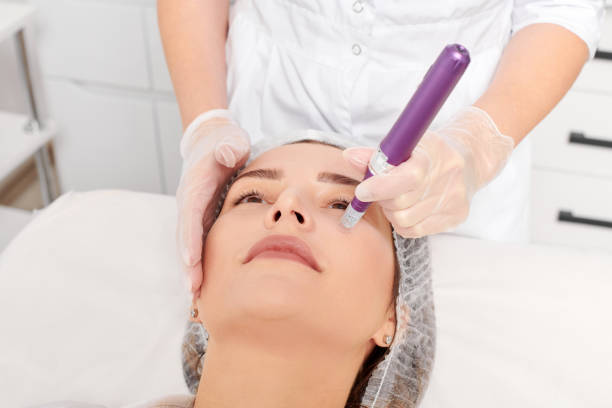 Can RF Microneedling reduce stubborn stretch marks