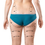 Can Sculpsure Body Contouring improve body symmetry