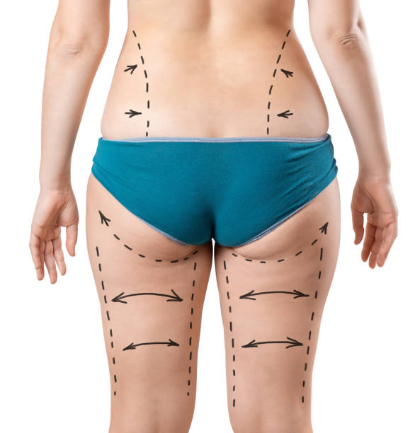Can Sculpsure Body Contouring improve body symmetry