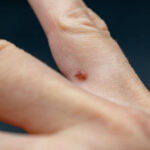 Can Warts Removal Treatment treat warts on fingers