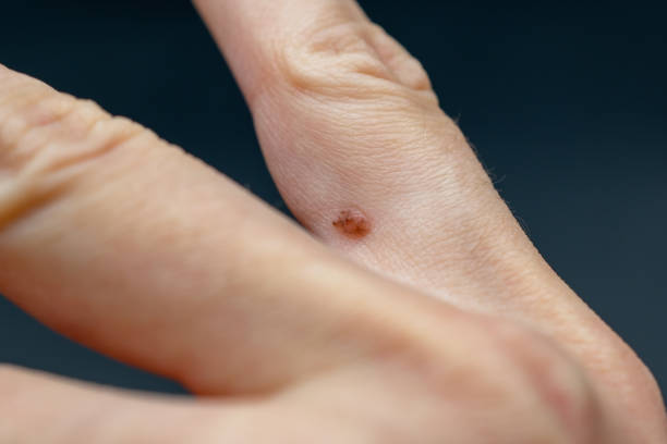 Can Warts Removal Treatment treat warts on fingers