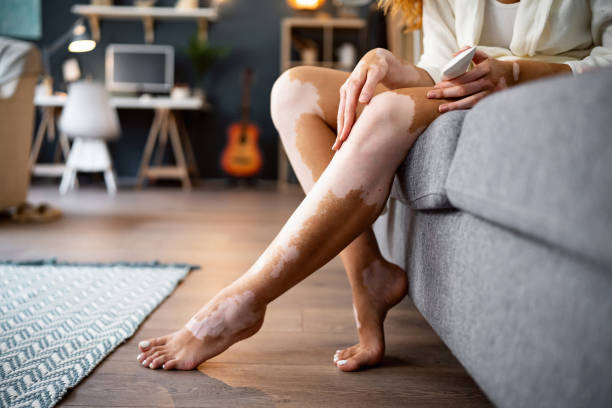 Does Vitiligo Treatment Work on Older White Patches