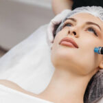 Is Microneedling for Acne Scars a lasting solution