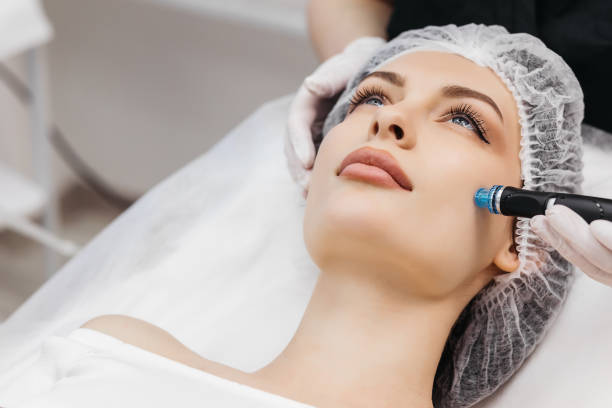 Is Microneedling for Acne Scars a lasting solution