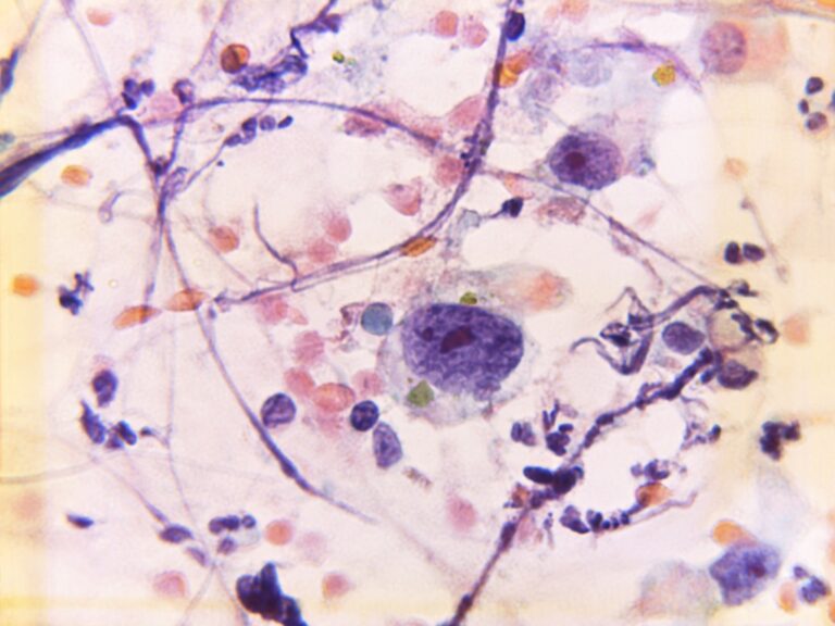 Calcified Uterine Leiomyoma