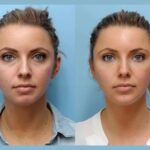 Thread lift treatments in Dubai: Subtle Elegant Beauty Enhancement for Facial Rejuvenation