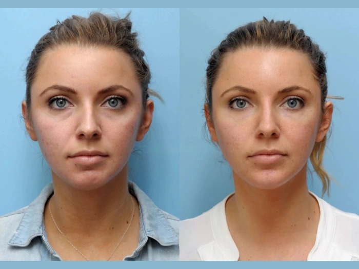 Thread lift treatments in Dubai: Subtle Elegant Beauty Enhancement for Facial Rejuvenation
