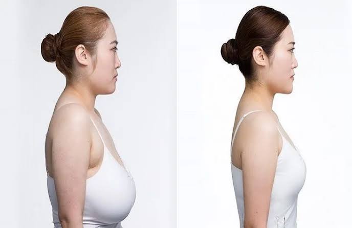 Breast Augmentation in Dubai