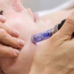 Microneedling in Manchester
