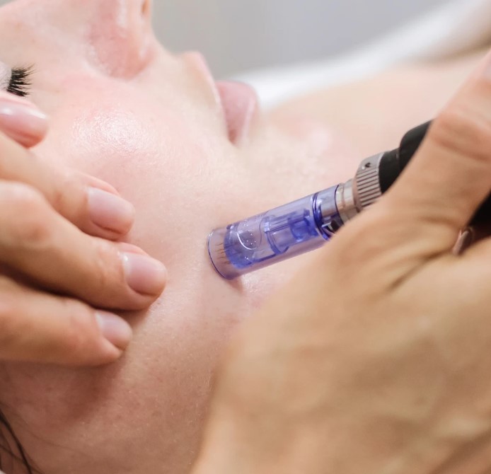 Microneedling in Manchester
