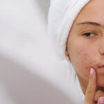 Acne Scar Removal in Dubai