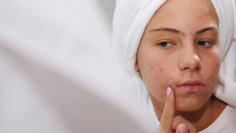 Acne Scar Removal in Dubai