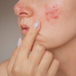 Can Laser Acne Scar Treatment improve cheek acne scars