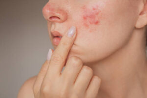 Can Laser Acne Scar Treatment improve cheek acne scars