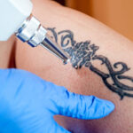 Can Laser Tattoo Removal treat tattoos near scar tissue