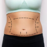 Can Mini Tummy Tuck Tighten Loose Lower Skin