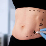 Does Laser Liposuction Provide Natural-Looking Results