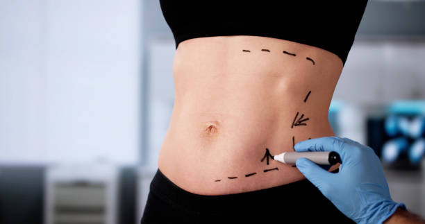 Does Laser Liposuction Provide Natural-Looking Results