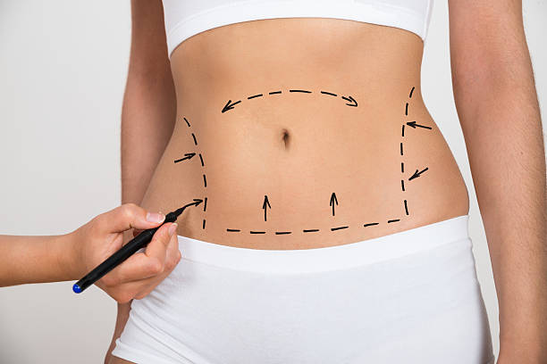Does Liposuction deliver gradual or immediate results