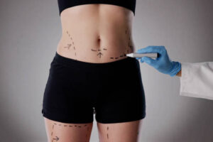 Does Tummy Tuck Surgery provide lasting results