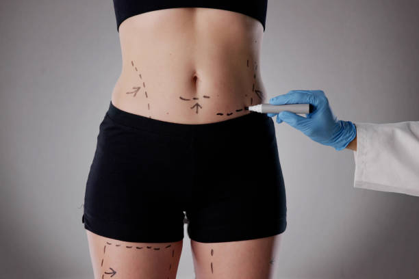 Does Tummy Tuck Surgery provide lasting results