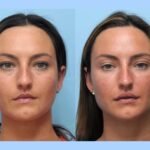 Thread Lift Treatment in Dubai Supporting Refined Beauty Through Advanced Technologies