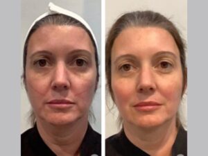 Best Plastic Surgeons in Dubai: Thread Lift with Personalized Facial Rejuvenation