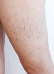 How Does Spider Vein Treatment Improve Leg Appearance