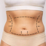 Is Lower Body Lift the Right Surgery for Loose Body Skin