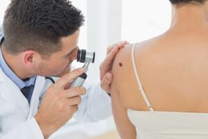 Moles-and-melanoma-a-mole-examination