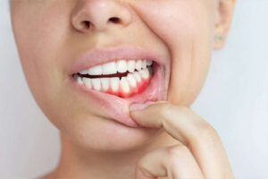 gum disease treatment sharjah