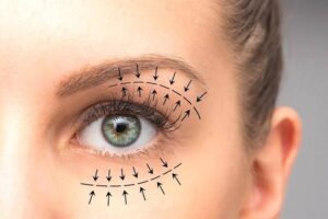 Upper Blepharoplasty In Dubai