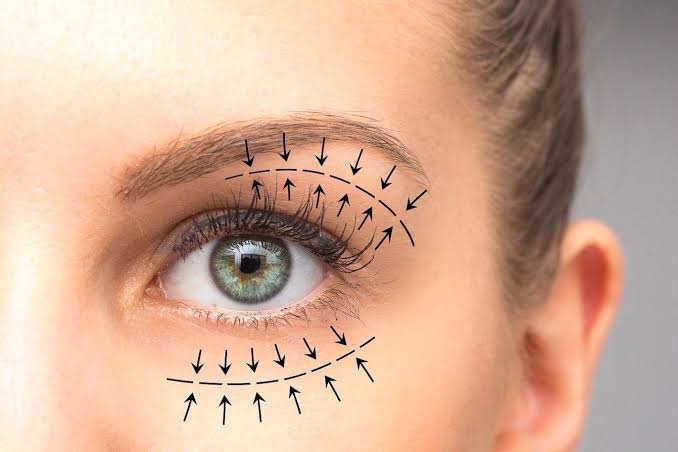 Upper Blepharoplasty In Dubai