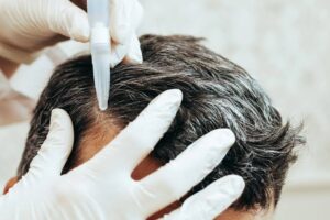 hair fall treatment in Dubai